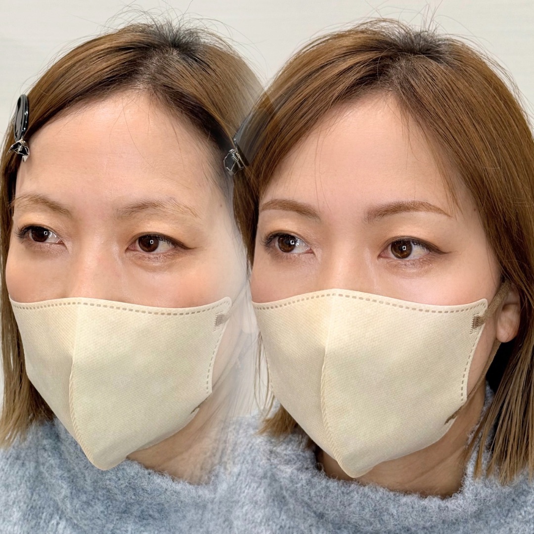医療アートメイク症例写真　｜眉｜パウダー｜ナチュラルアーチ眉　東京・恵比寿のアートメイクラボ