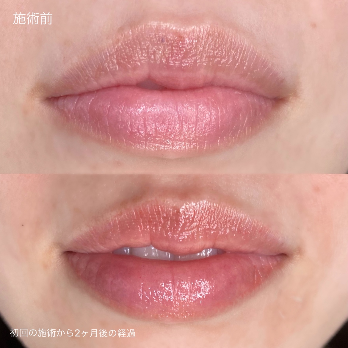 医療アートメイク症例写真　リップ　東京・恵比寿のアートメイクラボ