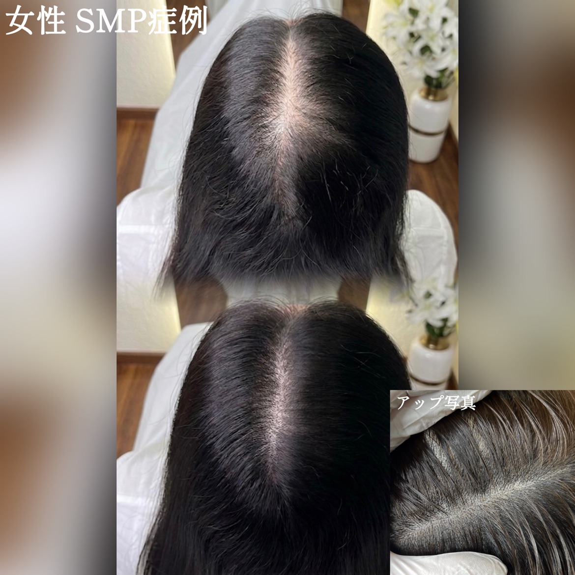 医療アートメイク症例写真　ヘアアートメイク　M字　東京・恵比寿のアートメイクラボ