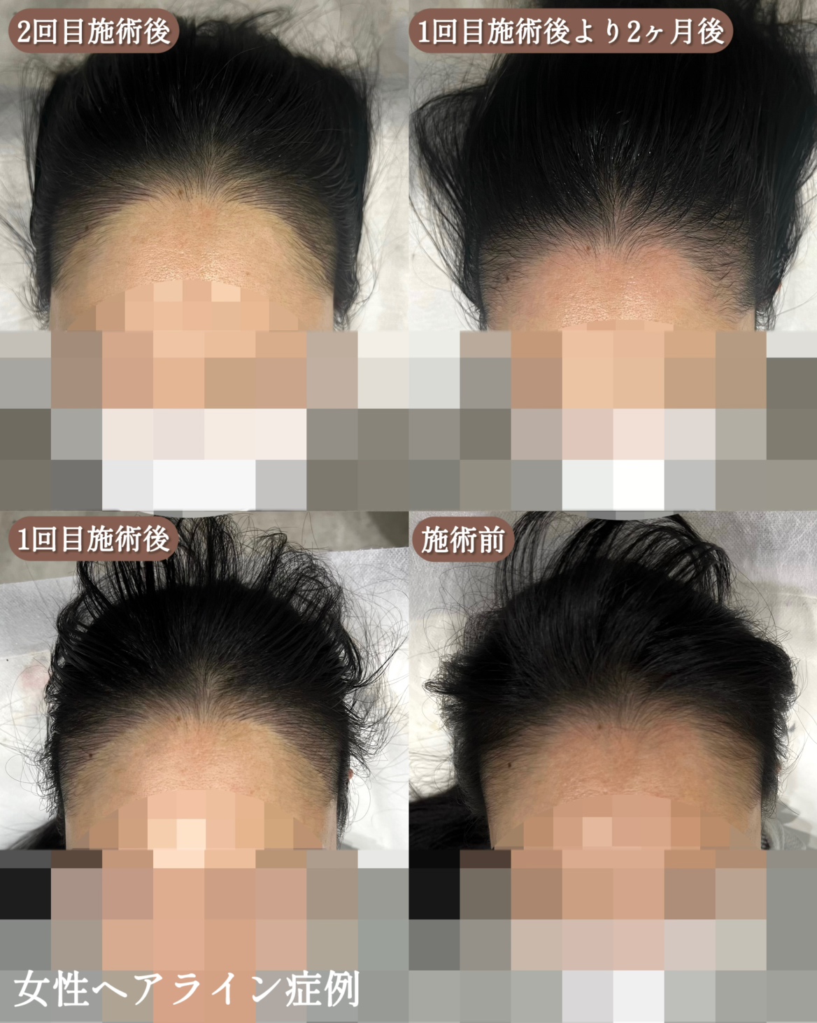 医療アートメイク症例写真　ヘアアートメイク　ヘアラインM字　ビフォーアフター　東京・恵比寿のアートメイクラボ