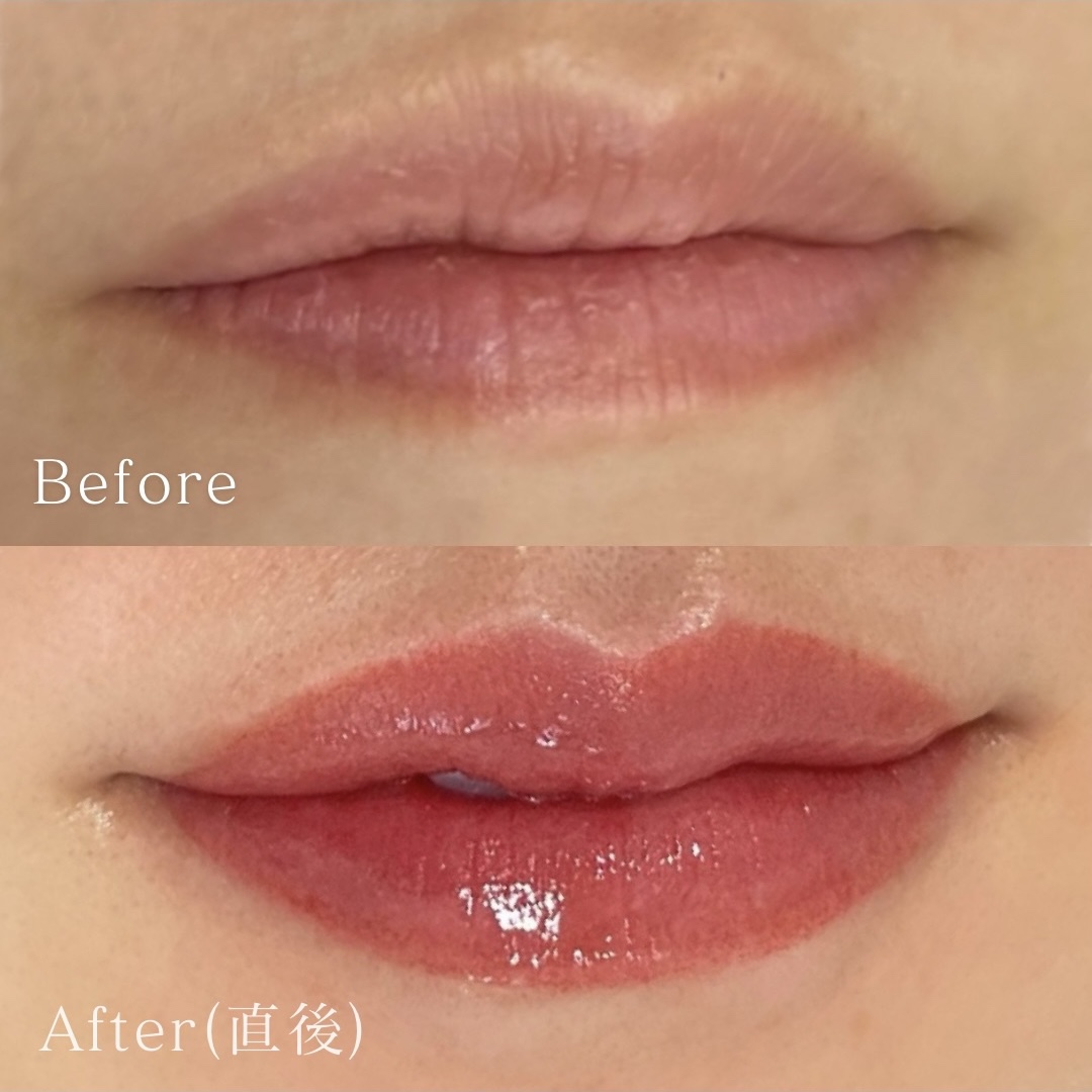 医療アートメイク症例写真　リップ　東京・恵比寿のアートメイクラボ